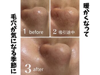 サロン ド モモ(salon de momo)/毛穴汚れにバイバイ