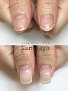 マリーロール 梅田店(Marie Laure)/深爪矯正/自爪育成/自爪風