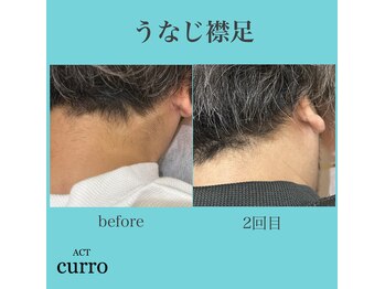 アクト クロ(ACT curro)/【うなじ襟足】脱毛施術例