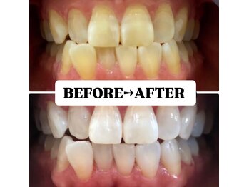 ホワイトニングサロン 豊中/Before&After美白ホワイトニング