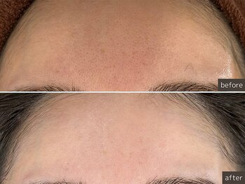 SEC(Shizuoka esthetic company)/【毛穴洗浄】キュッと引き締め