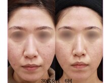 ブレア(Blair)/マイクロニードル×ピンクグロウ