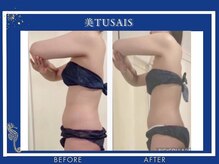 ビテュセ(美Tu sais)/【痩身・ダイエット】ボディケア