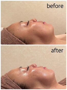 リリィ(RIRY)/フェイシャル　ビフォーアフター