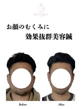 アロエベル(aloe Belle)&nbsp;美容鍼 小顔矯正