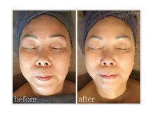 アン グレーヌ 自由が丘(unegraine)/輪郭すっきり！なめらかお肌♪