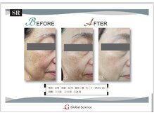 アンス(Ance)/光フェイシャル☆ビフォア♪