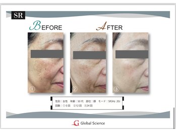 アンス(Ance)/光フェイシャル☆ビフォア♪