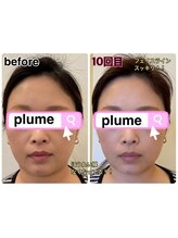 プルーム 久留米店(plume)/小顔矯正