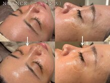 コアラル 麻布十番(COALALU)/CHRISTIAN ニュアンス［毛穴］