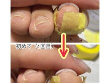 ネイルサロンアンドスクールラボ(LABO)/フット☆巻き爪矯正