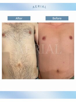 エアリアル 武雄店/男性の胸毛脱毛