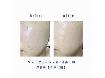 ミセル 尾道店(MYTHEL)/before after 光フェイシャル