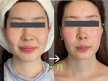 セレブリボーン 大阪ボーテ/ヒト幹細胞/エイジングケア