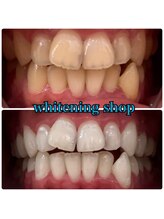 ホワイトニングショップ 武蔵小杉店/武蔵小杉ホワイトニング美白ケア