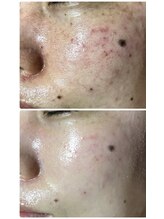 ビューティーガーデン(Beauty Garden)/集中プログラム