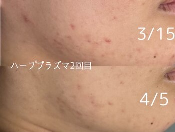 ロイ 初生店(LOI)/ハーブ×プラズマ