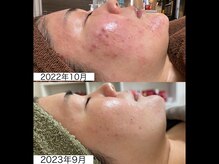 ナニミー(Nani.me)の雰囲気（ニキビケア・赤みにもハーブピーリング！）