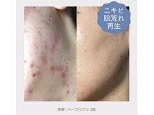 ノイ(Noi)の雰囲気（お肌の色ムラ・凸凹肌・毛穴ハーブリプロ/ハーブピーリング）