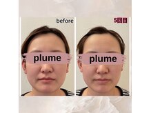 プルーム 大橋店(plume)の雰囲気（【小顔矯正】半年の変化/30代女性/骨格矯正）