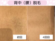 ウルル 金山駅前店(ULULU)/背面の脱毛