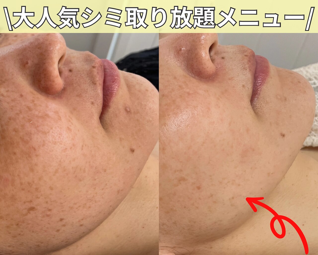 REVI ハーブピーリング 大阪に関するエステサロン 心斎橋 REVI
