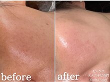 ボニータアンジュ 恵比寿(Bonita Ange)/渋谷ハーブピーリング｜症例