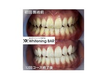 ホワイトニングバー 心斎橋オーパ店/12回照射で本来の理想の白さへ