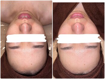 エルマナ(Hermana)/毛穴ケアビフォーアフター