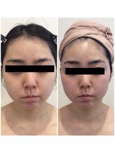 ミエル(Miel)/Before After