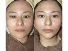 ユウユウ(YUYU)/プラズマフェイシャル