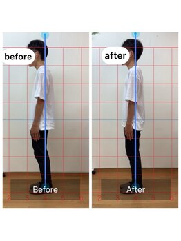 朱雀整骨院/姿勢矯正before after
