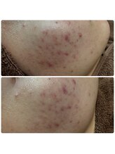 アレーズファイブフォー(A’LAISE54)/ニキビケア