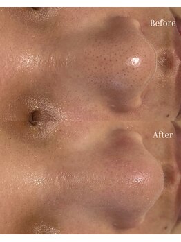 ベリスユイット(BELLIS HUIT)/【毛穴吸引でいちご鼻解消☆】