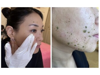 ヨノ(Yono)/シーナジーピーリング