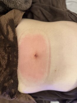 リラ(RILA)/脂肪冷却直後