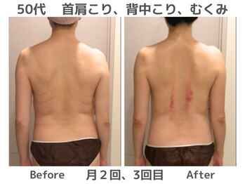 マテリアル(MATERIAL)/首肩背中こり放置と背中むくみ