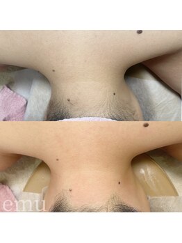 エミュ(emu)/背中＆うなじwax