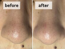 エアル(earu.)/BA|毛穴ケア|ピーリング|高円寺