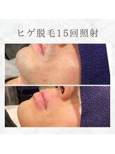 ボゴス(BOGOSS)/ヒゲ脱毛15回照射