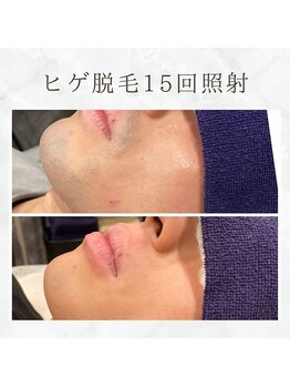 ボゴス(BOGOSS)/ヒゲ脱毛15回照射