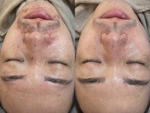 ビーマジック(Be Magic)/メンズ/毛穴/眉毛/ニキビ