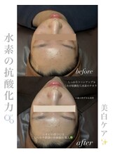 シュシュ(chouchou)/毛穴洗浄ハイドロフェイシャル