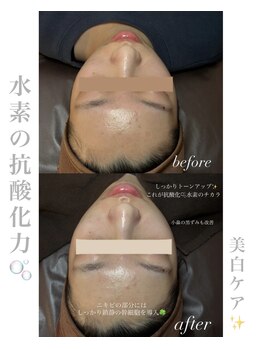 シュシュ(chouchou)/毛穴洗浄ハイドロフェイシャル