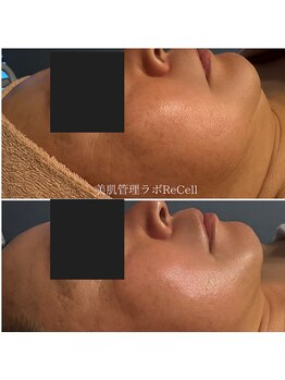 リセル 月島(ReCeLL)の写真/ホウレイ線/たるみ肉を一気に削ぎ落とす！KIWAMI RF・EMS・PO・IPL・サーマルフラクショナル×美容溶解◎