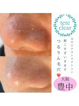 プリュネル(Prunelle)/毛穴エクストラクション