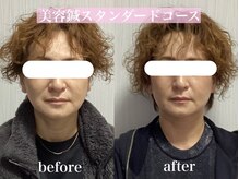 サロン ド ハリッシュ(Salon de HARISH)/美容鍼スタンダードコース