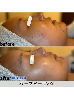 ルアナ 北谷店/ハーブピーリング 《沖縄/北谷》