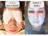 【人気NO2★】Vラインが際立つ360度小顔へ!mielia式美容鍼左右24本＋通電4本