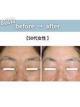 ほねつぎ市川はりきゅう接骨院/クー(kuu)/【πテラピー】before after